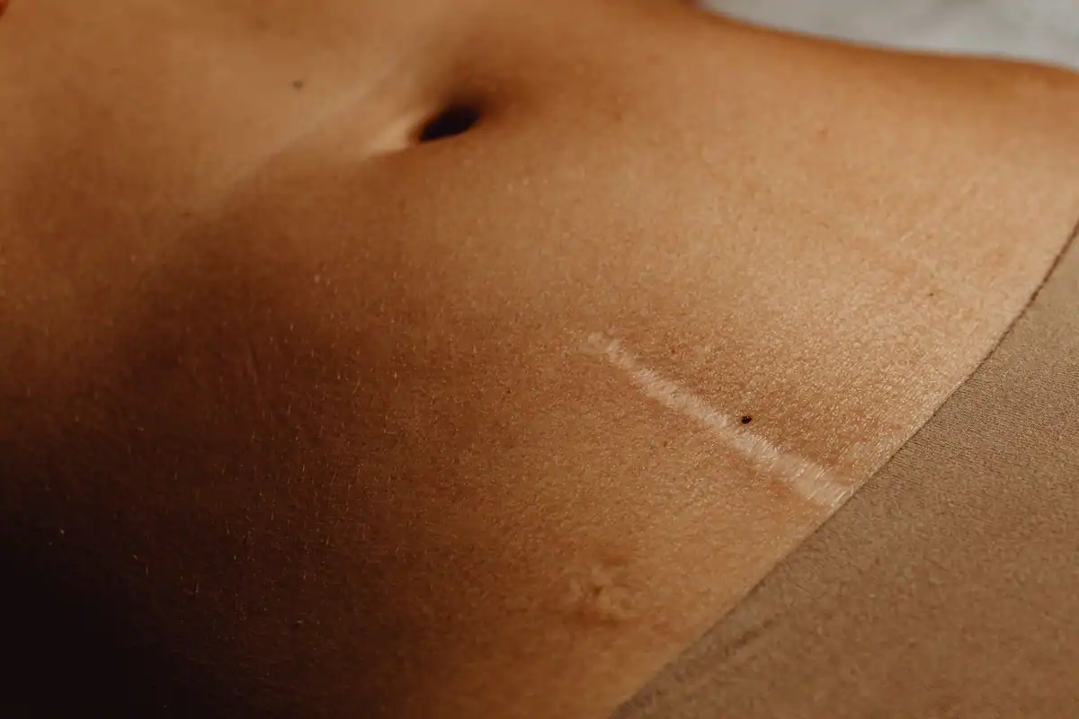 Abdomen cu o cicatrice subțire și câteva alunițe, fotografiat de aproape