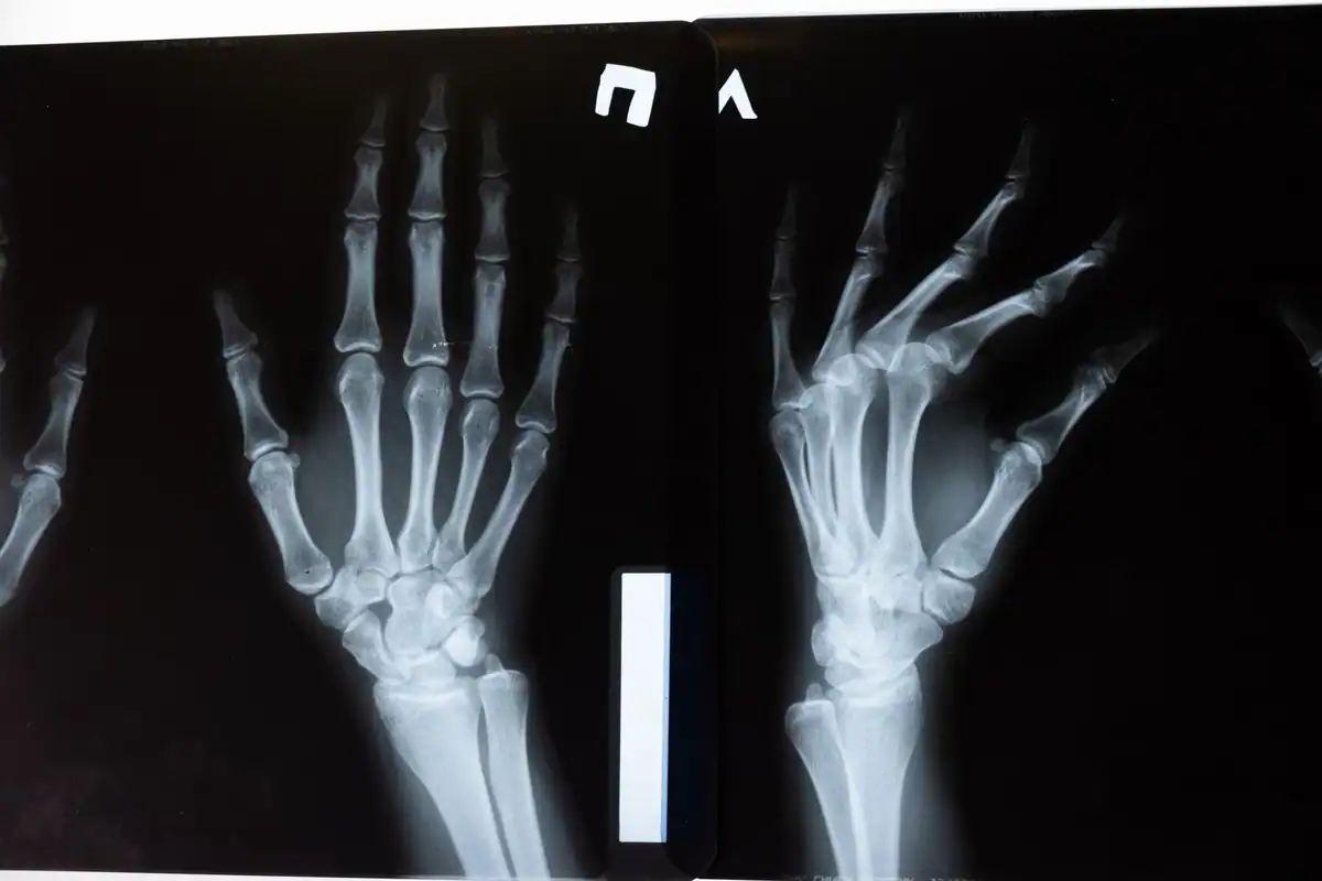 Radiografie a două mâini, cu oasele și articulațiile degetelor foarte clare