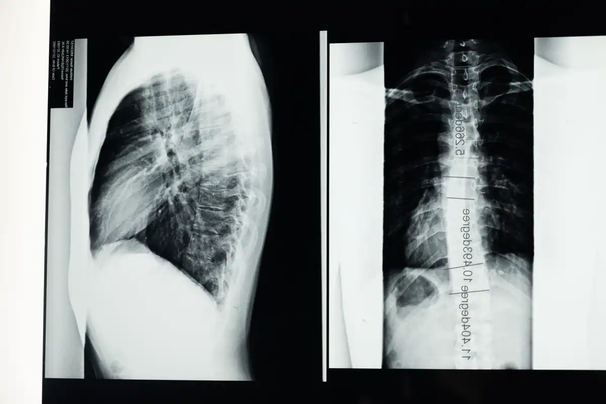 Două radiografii ale toracelui și coloanei vertebrale, afișate pe un panou luminos